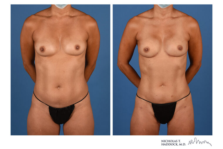 PAP Flap Before and After Photo PAP Flap Before and After Photo