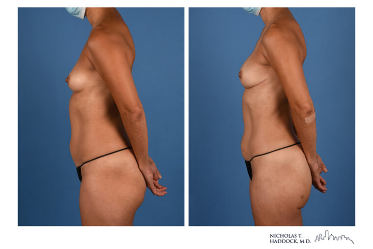 PAP Flap Before and After Photo PAP Flap Before and After Photo