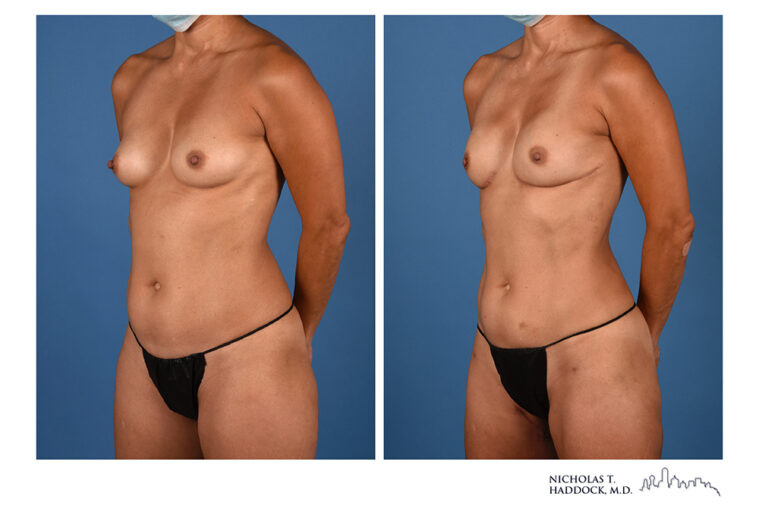 PAP Flap Before and After Photo PAP Flap Before and After Photo