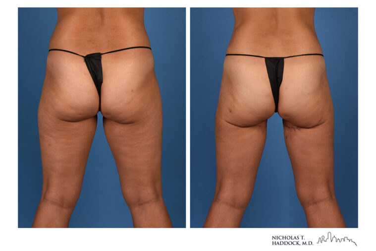 PAP Flap Before and After Photo PAP Flap Before and After Photo