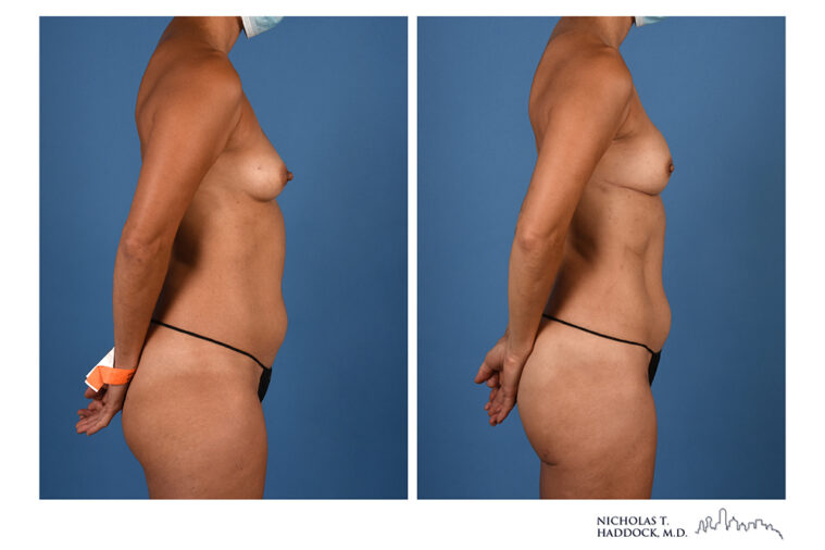 PAP Flap Before and After Photo PAP Flap Before and After Photo