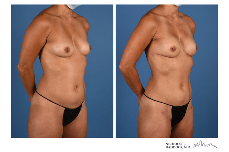 PAP Flap Before and After Photo PAP Flap Before and After Photo