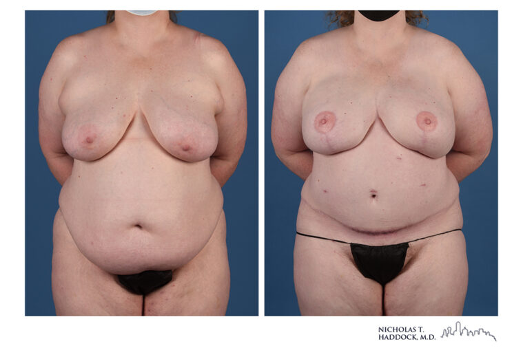 DIEP Flap Before and After Photo DIEP Flap Before and After Photo