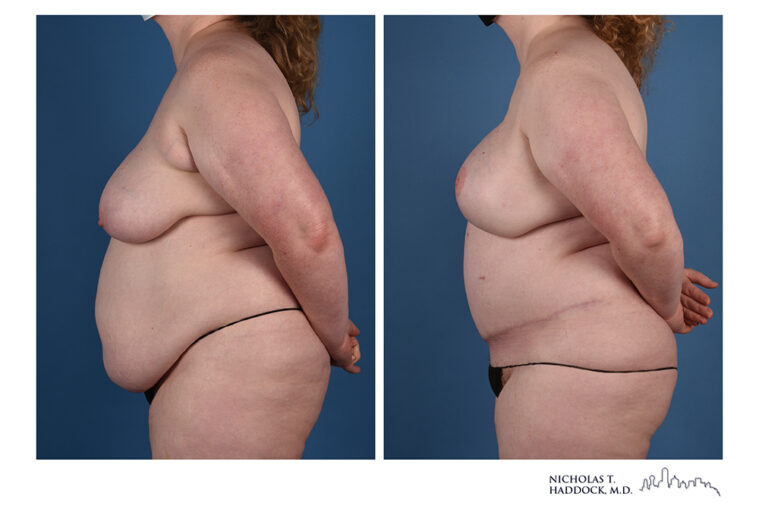 DIEP Flap Before and After Photo DIEP Flap Before and After Photo