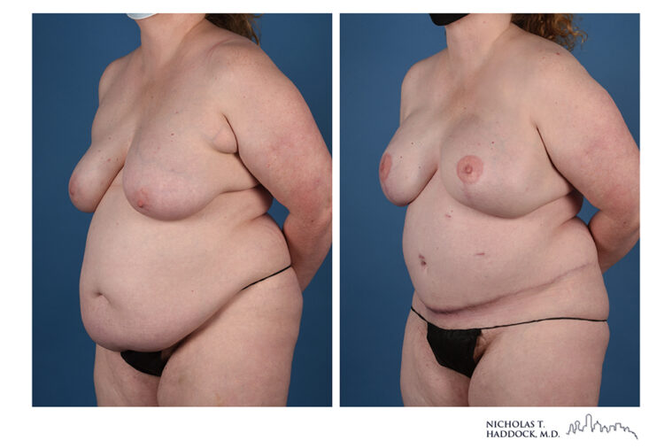 DIEP Flap Before and After Photo DIEP Flap Before and After Photo