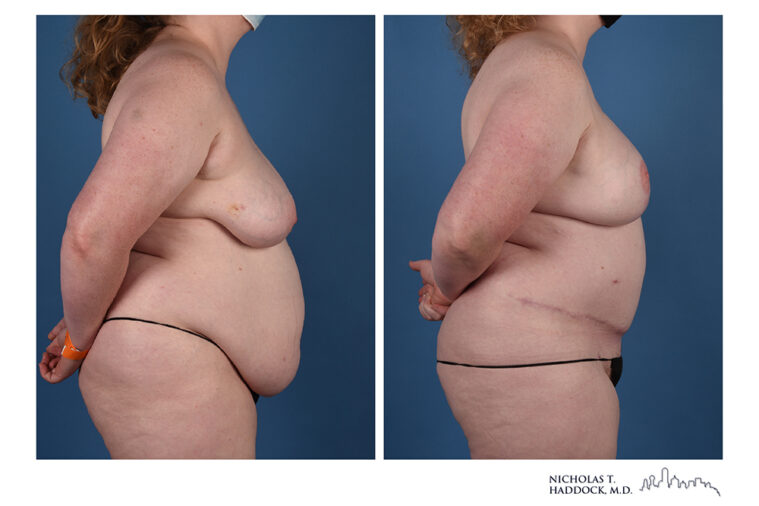 DIEP Flap Before and After Photo DIEP Flap Before and After Photo