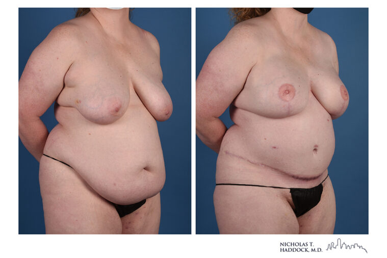DIEP Flap Before and After Photo DIEP Flap Before and After Photo