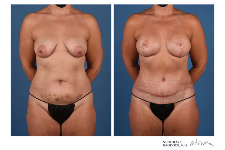 DIEP Flap Before and After Photo DIEP Flap Before and After Photo
