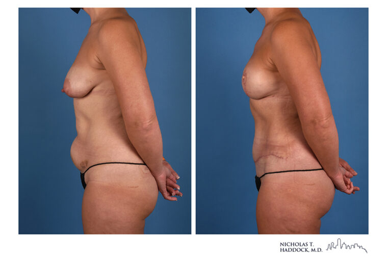 DIEP Flap Before and After Photo DIEP Flap Before and After Photo
