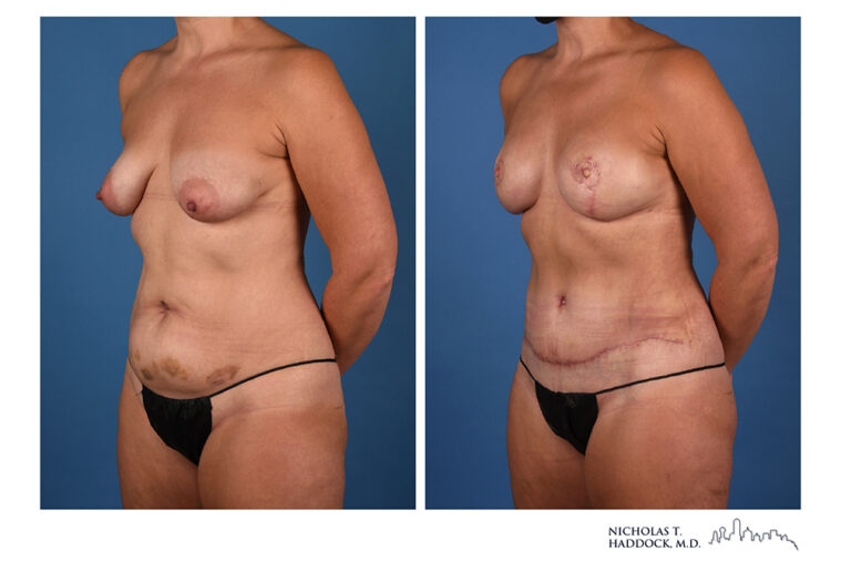 DIEP Flap Before and After Photo DIEP Flap Before and After Photo