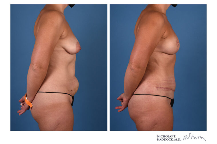 DIEP Flap Before and After Photo DIEP Flap Before and After Photo