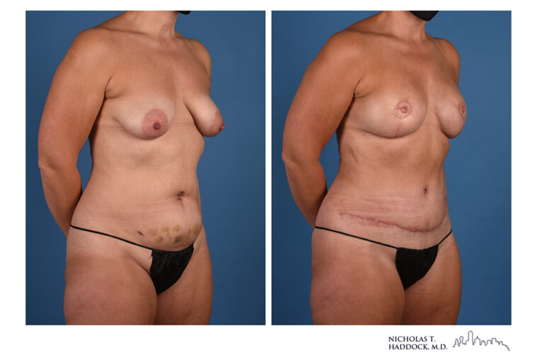 DIEP Flap Before and After Photo DIEP Flap Before and After Photo