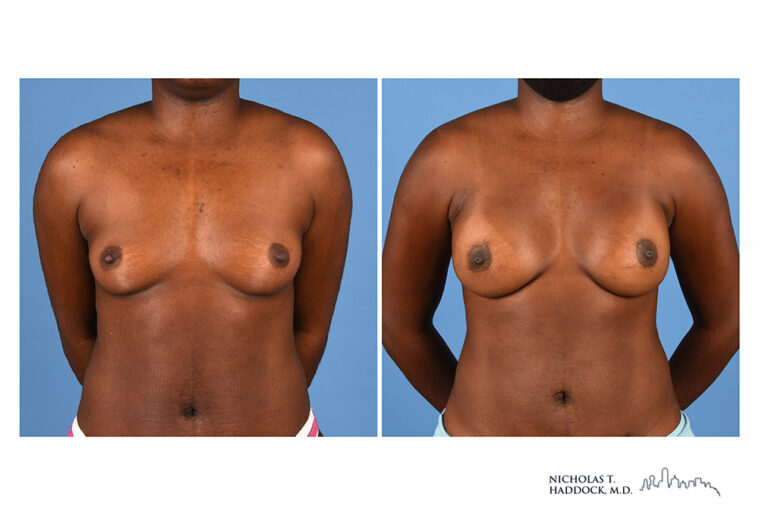 Implant Breast Reconstruction Before and After Photo Implant Breast Reconstruction Before and After Photo
