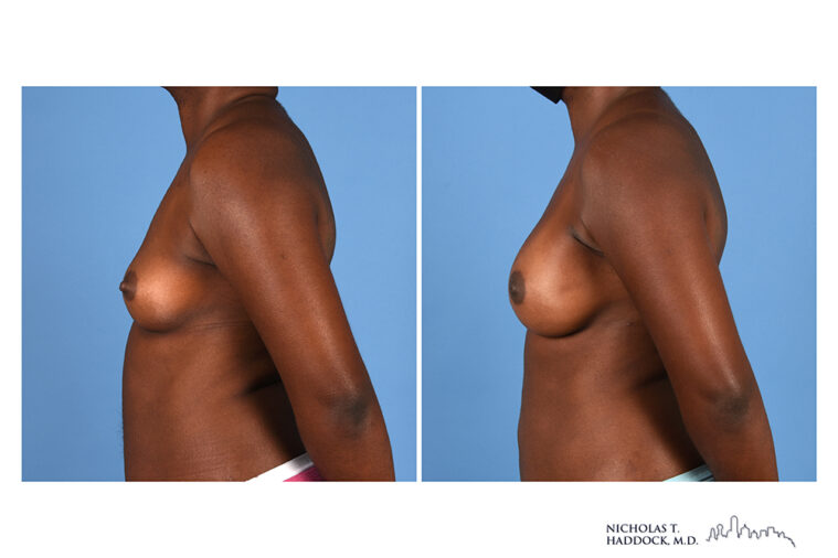 Implant Breast Reconstruction Before and After Photo Implant Breast Reconstruction Before and After Photo