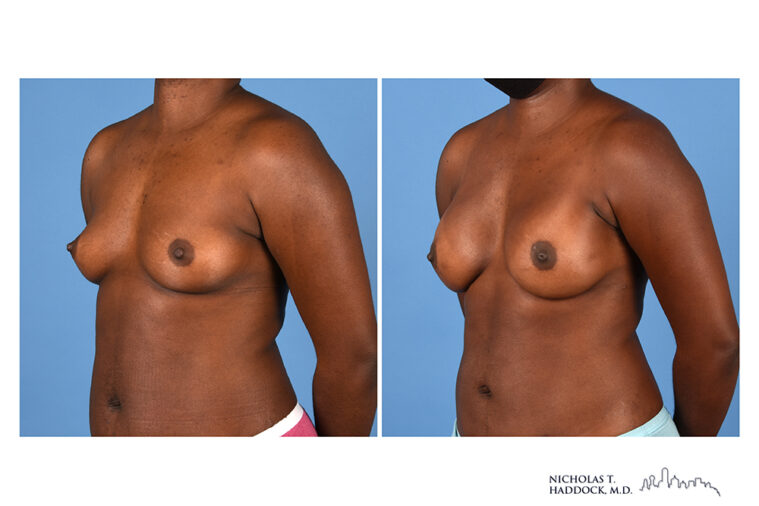 Implant Breast Reconstruction Before and After Photo Implant Breast Reconstruction Before and After Photo