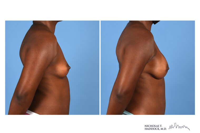 Implant Breast Reconstruction Before and After Photo Implant Breast Reconstruction Before and After Photo