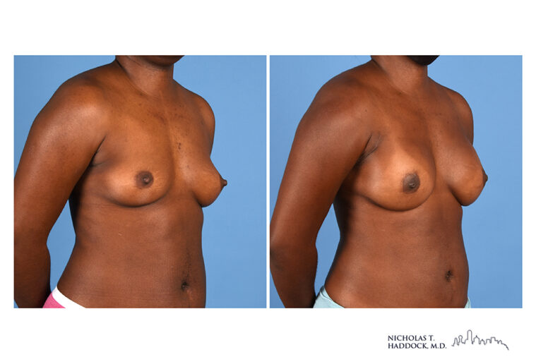 Implant Breast Reconstruction Before and After Photo Implant Breast Reconstruction Before and After Photo