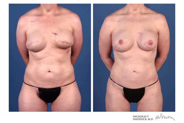 PAP flap Before and After Photo PAP flap Before and After Photo
