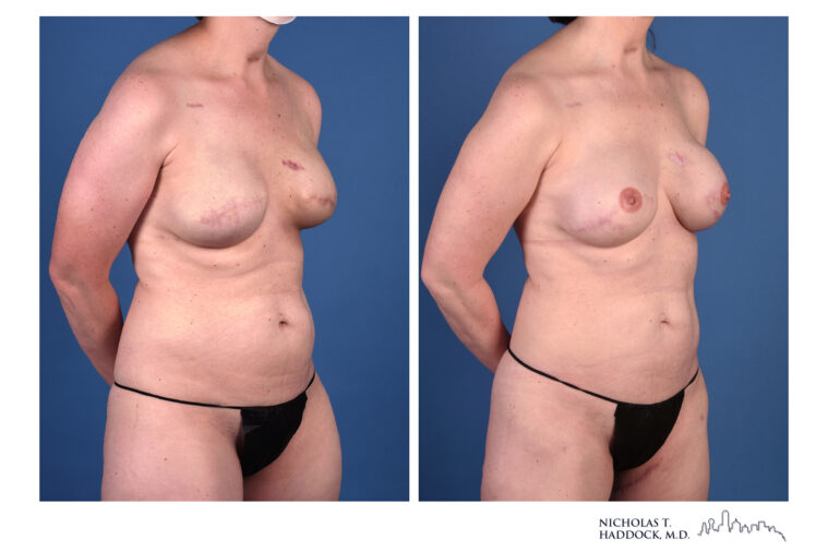 PAP flap Before and After Photo PAP flap Before and After Photo