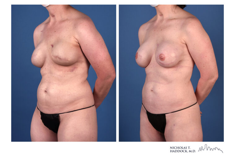 PAP flap Before and After Photo PAP flap Before and After Photo