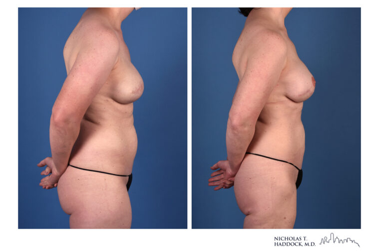 PAP flap Before and After Photo PAP flap Before and After Photo