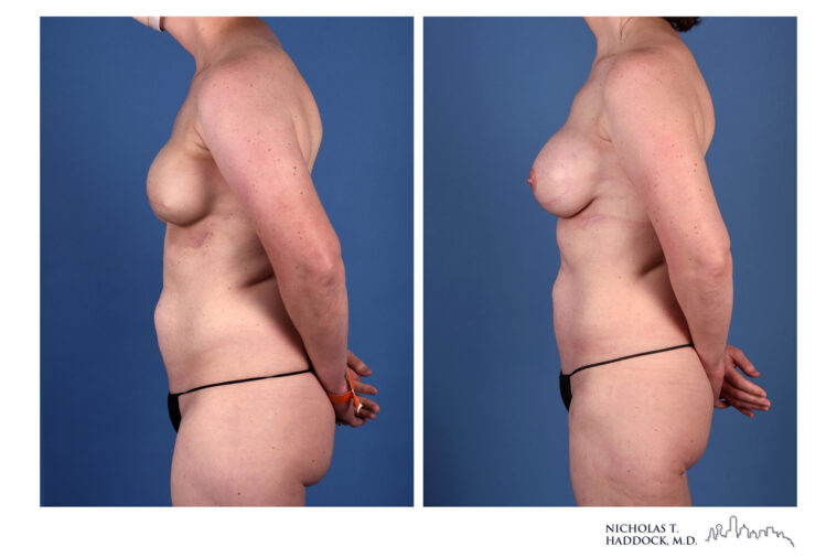 PAP flap Before and After Photo PAP flap Before and After Photo