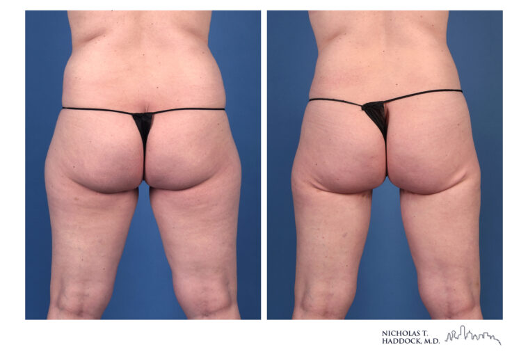 PAP flap Before and After Photo PAP flap Before and After Photo