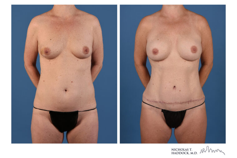 DIEP Flap Before and After Photo DIEP Flap Before and After Photo