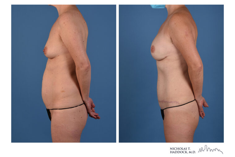 DIEP Flap Before and After Photo DIEP Flap Before and After Photo