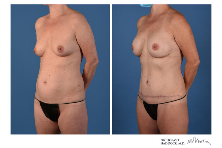 DIEP Flap Before and After Photo DIEP Flap Before and After Photo