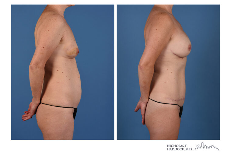 DIEP Flap Before and After Photo DIEP Flap Before and After Photo