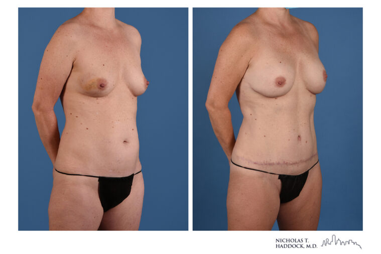 DIEP Flap Before and After Photo DIEP Flap Before and After Photo