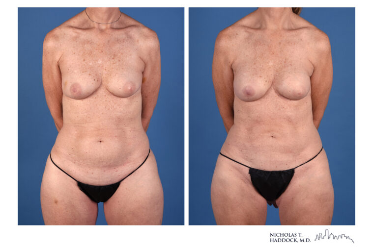 PAP Flap Before and After Photo PAP Flap Before and After Photo