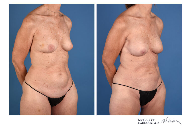 PAP Flap Before and After Photo PAP Flap Before and After Photo