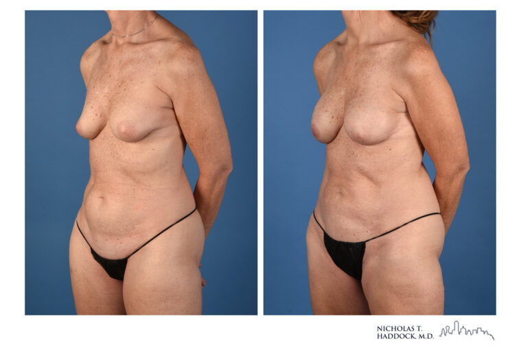 PAP Flap Before and After Photo PAP Flap Before and After Photo
