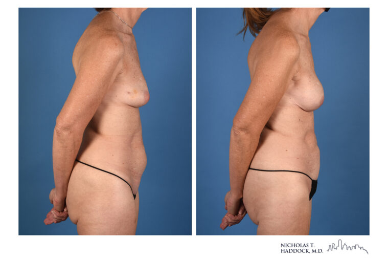 PAP Flap Before and After Photo PAP Flap Before and After Photo