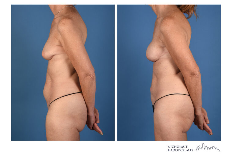 PAP Flap Before and After Photo PAP Flap Before and After Photo