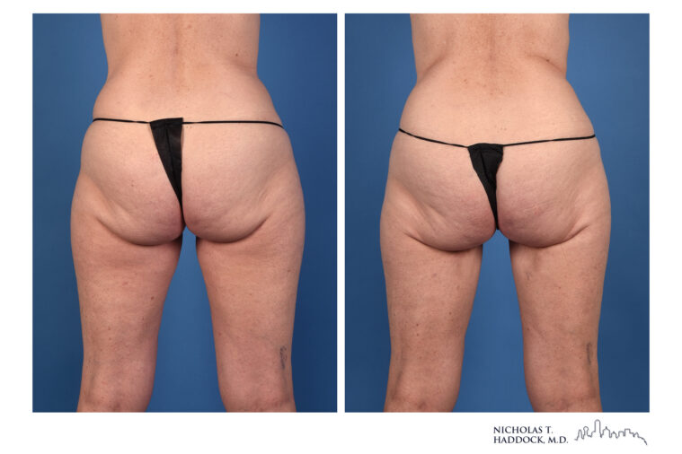 PAP Flap Before and After Photo PAP Flap Before and After Photo