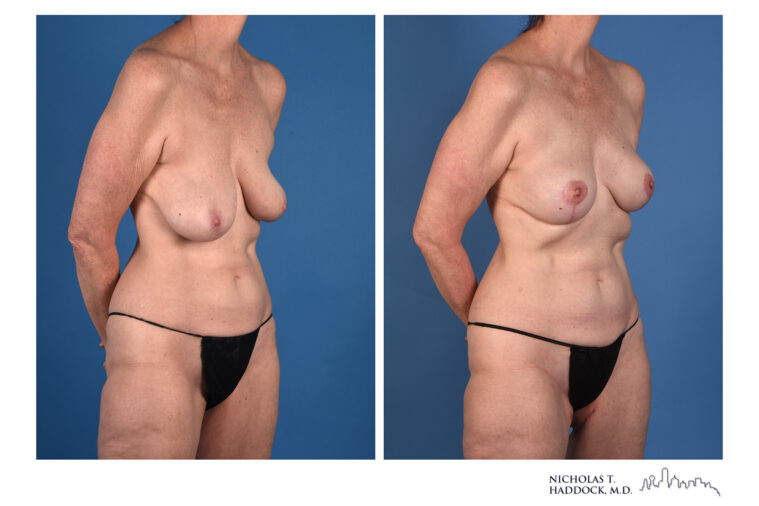 PAP Flap Before and After Photo PAP Flap Before and After Photo