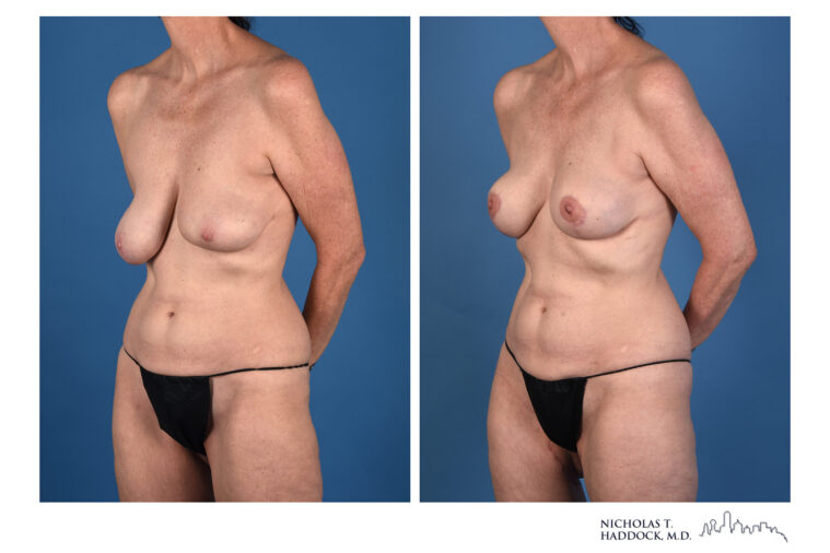PAP Flap Before and After Photo PAP Flap Before and After Photo