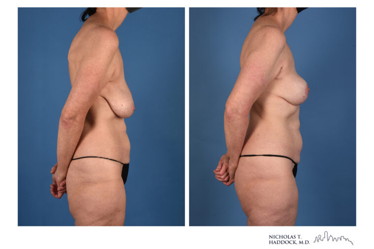 PAP Flap Before and After Photo PAP Flap Before and After Photo