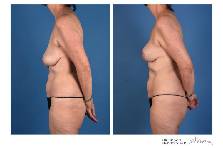 PAP Flap Before and After Photo PAP Flap Before and After Photo