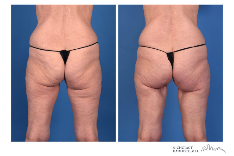 PAP Flap Before and After Photo PAP Flap Before and After Photo