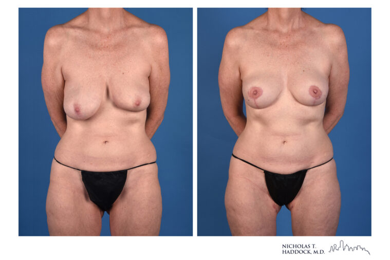 PAP Flap Before and After Photo PAP Flap Before and After Photo