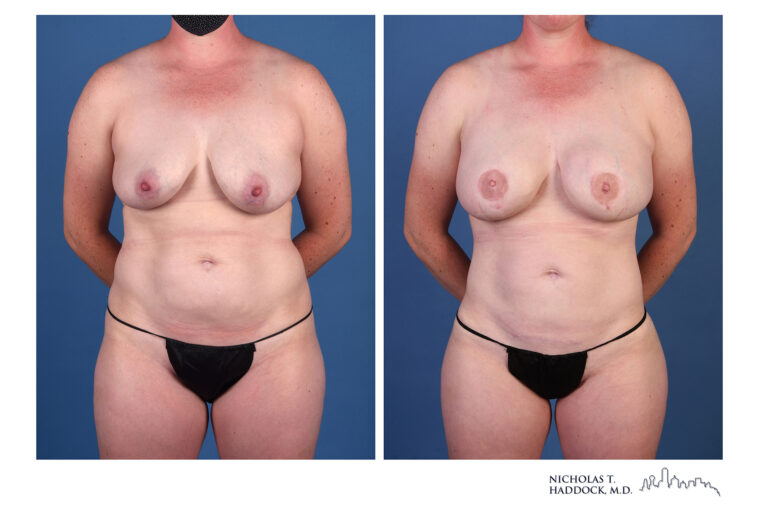 LAP flap Before and After Photo LAP flap Before and After Photo