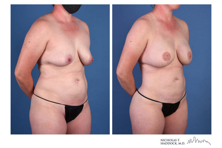 LAP flap Before and After Photo LAP flap Before and After Photo