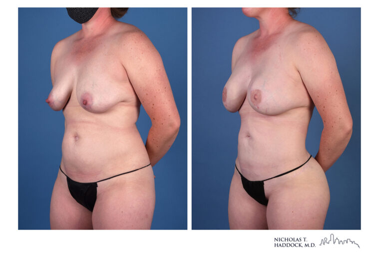 LAP flap Before and After Photo LAP flap Before and After Photo