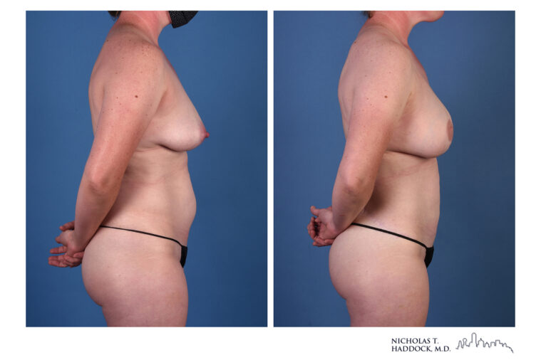 LAP flap Before and After Photo LAP flap Before and After Photo