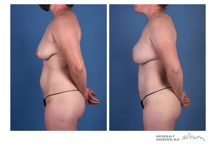 LAP flap Before and After Photo LAP flap Before and After Photo