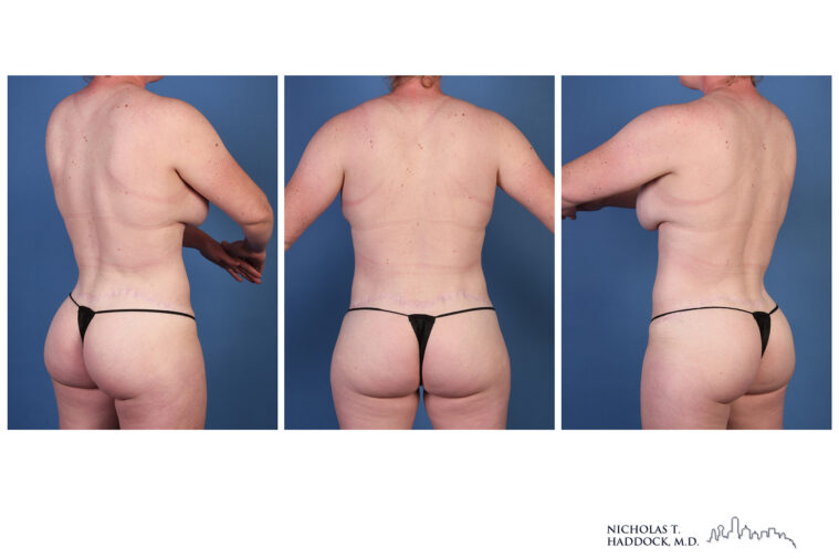 LAP flap Before and After Photo LAP flap Before and After Photo